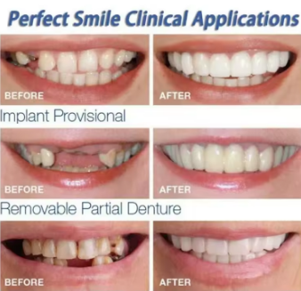 Perfect Fit Teeth Whitening Fake Tooth Cover Snap on Silicone Smile Veneers Teeth Flexibles Fake Teeth Dental Whitening Devices