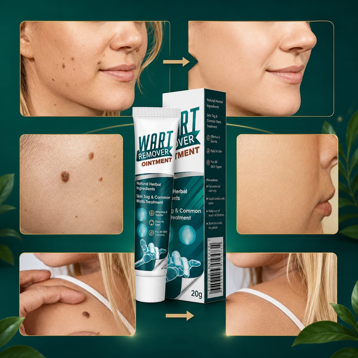 Wart remover ointment for wart removal